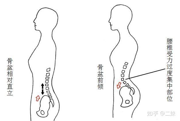 女孩尾骶骨突出图片