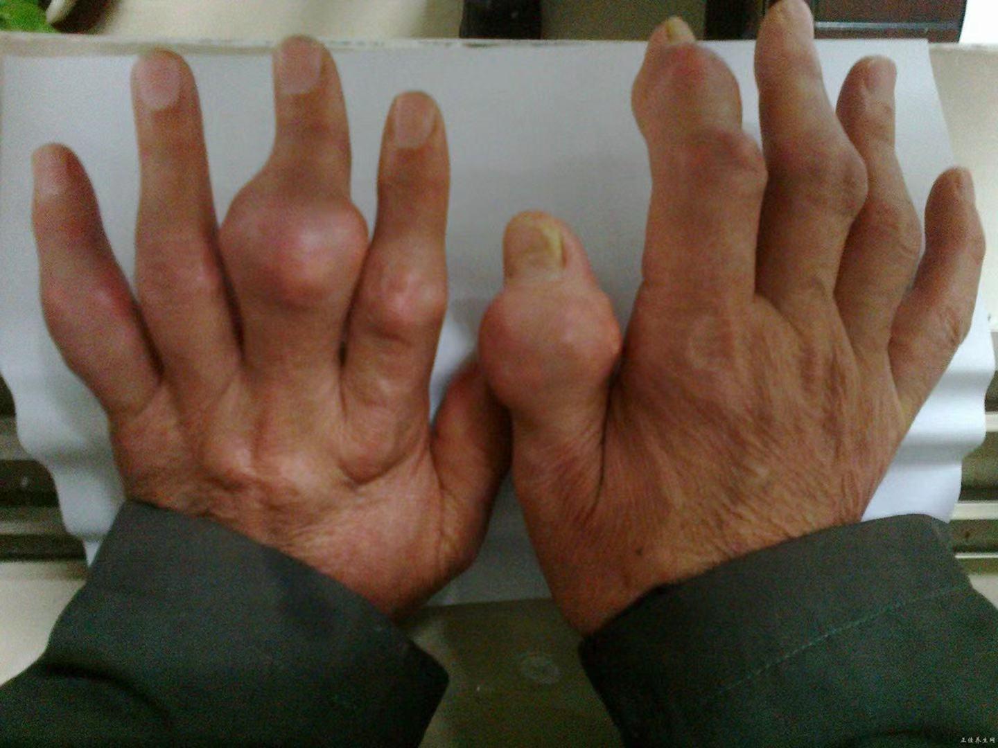 177亿高尿酸血症患者竟是豆制品害的吗这三种食物才是元凶