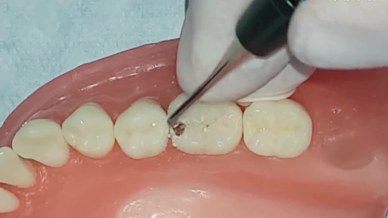 牙齿蛀牙牙医口腔科口腔健康相关推荐 2:31无痛式窝沟龋坏修复过程,一
