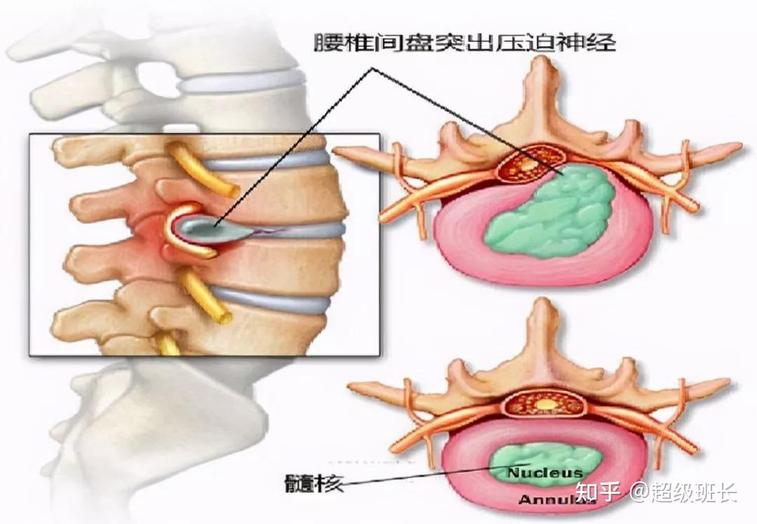 腰椎生理曲度改變,除了容易引發肌肉疲勞,造成痠痛的症狀外,最大的