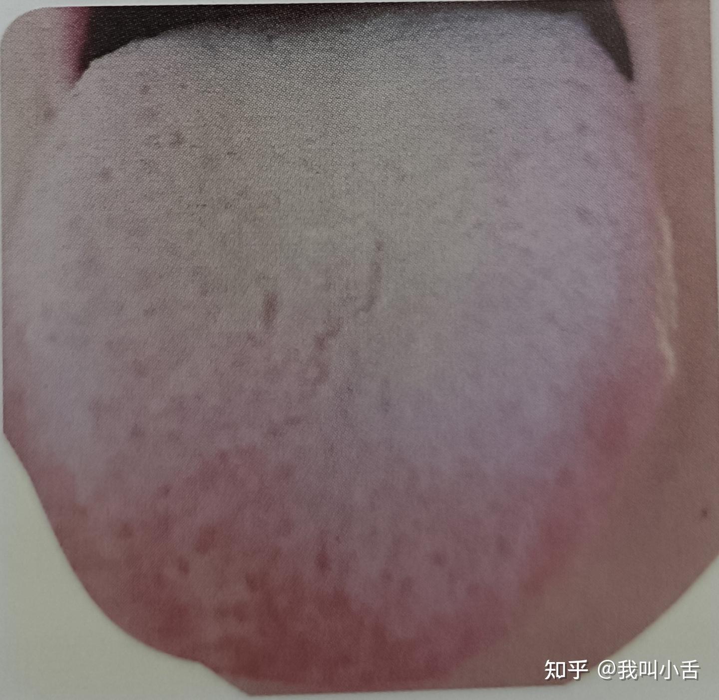 舌头的前世今生——望舌质——望舌形（胖大舌） - 知乎