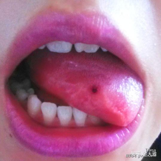 舌头边有黑斑的图片图片