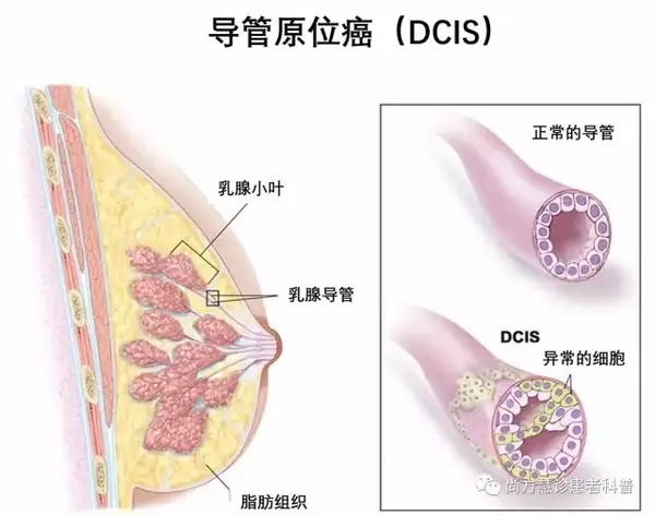 一文读懂乳腺导管 小叶原位癌 Carcinoma In Situ 的诊断和治疗 知乎