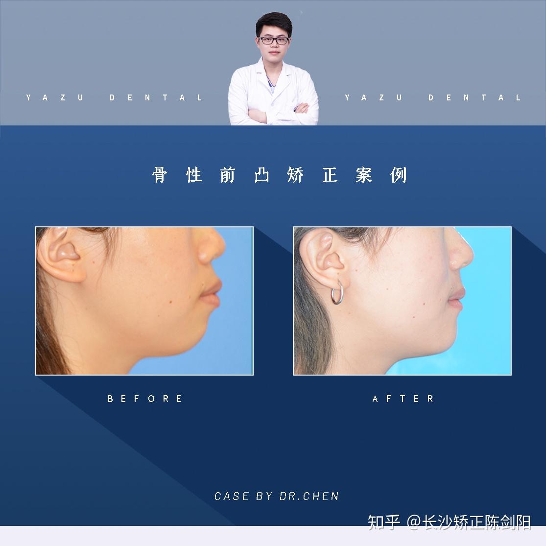 案例集:整牙胜过整形,看矫正对侧面改善变化。 - 知乎