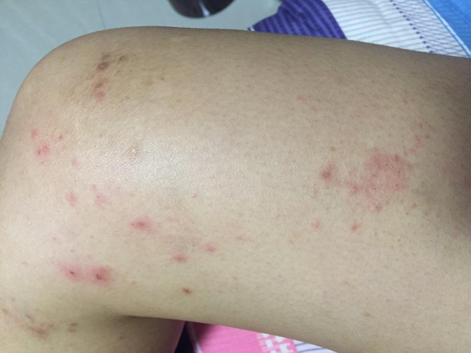 全身基本都有疹子医生说是泛发性湿疹西医中医都看了但是还没好怎么办