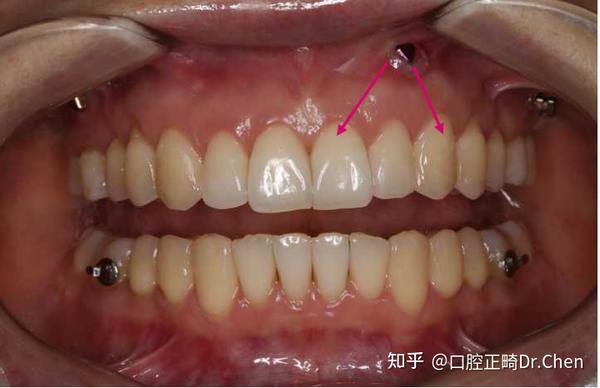 缩短牙冠高度;再如后牙多根牙的压低,需要额外的力量帮忙,否则牙根的