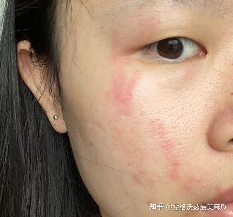 记录第一次得隐翅虫皮炎