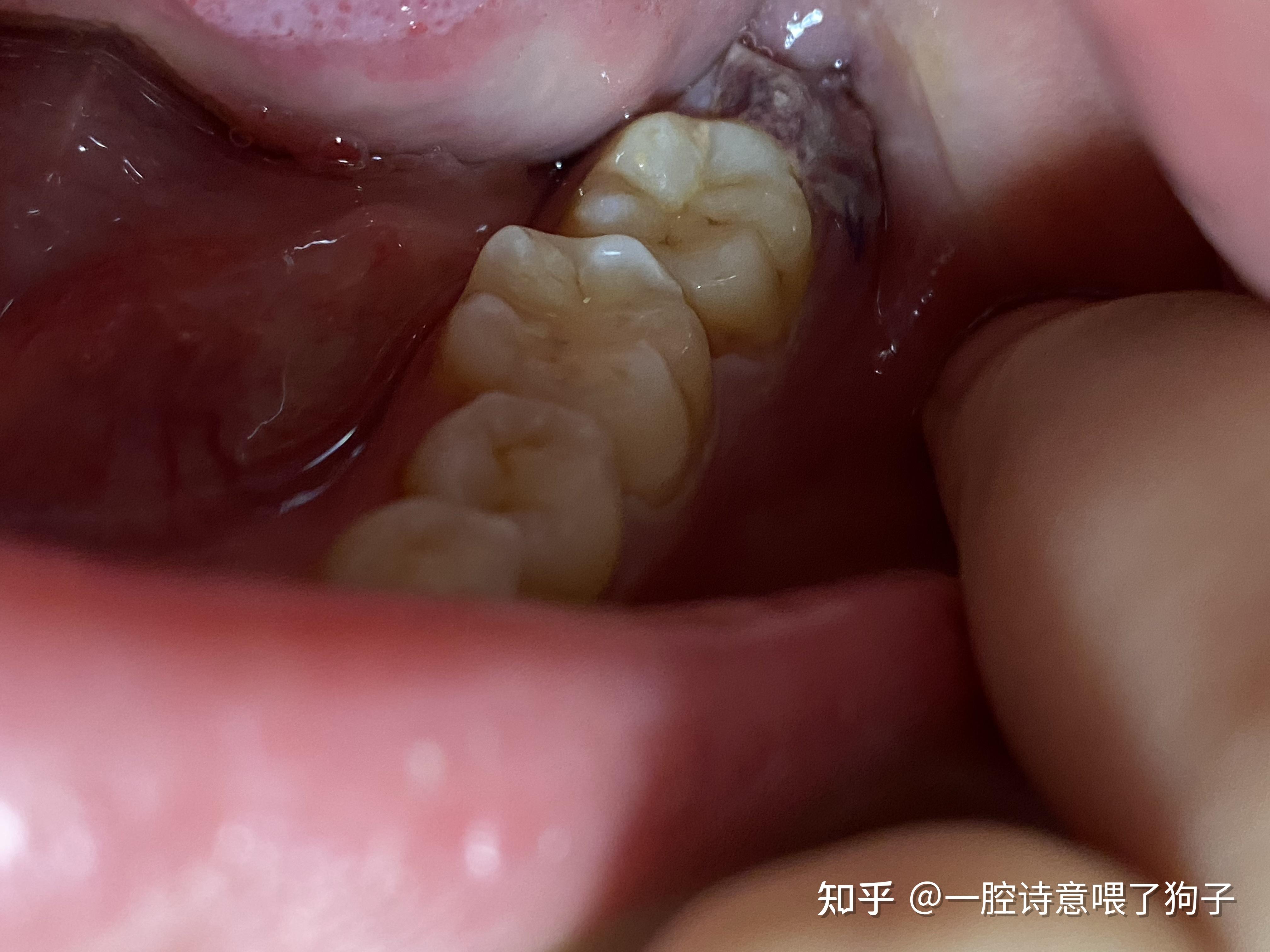 拔完智齿第三天以后每天晚上疼醒怎么办今天第五天了