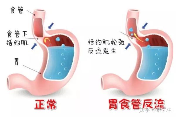 胃酸反流？你不是因为胃酸过多，而是胃酸过少！ - 知乎