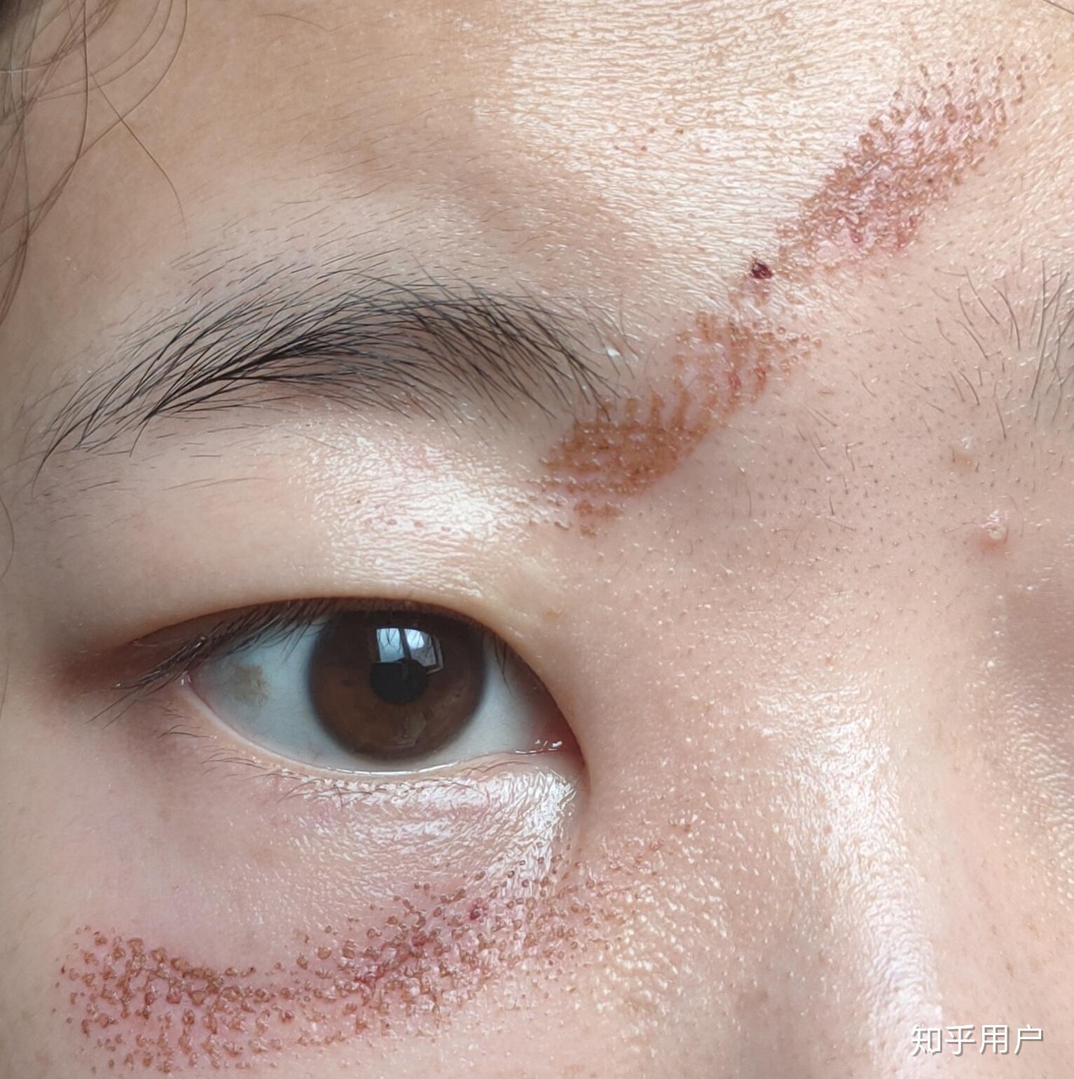 知乎里,有人做过激光祛疤手术吗?可以说一下效果和感受吗? - 知乎