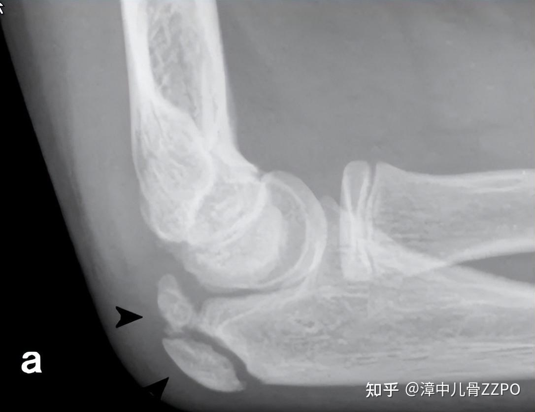想读懂儿童肘关节x线,至少你该会这些!