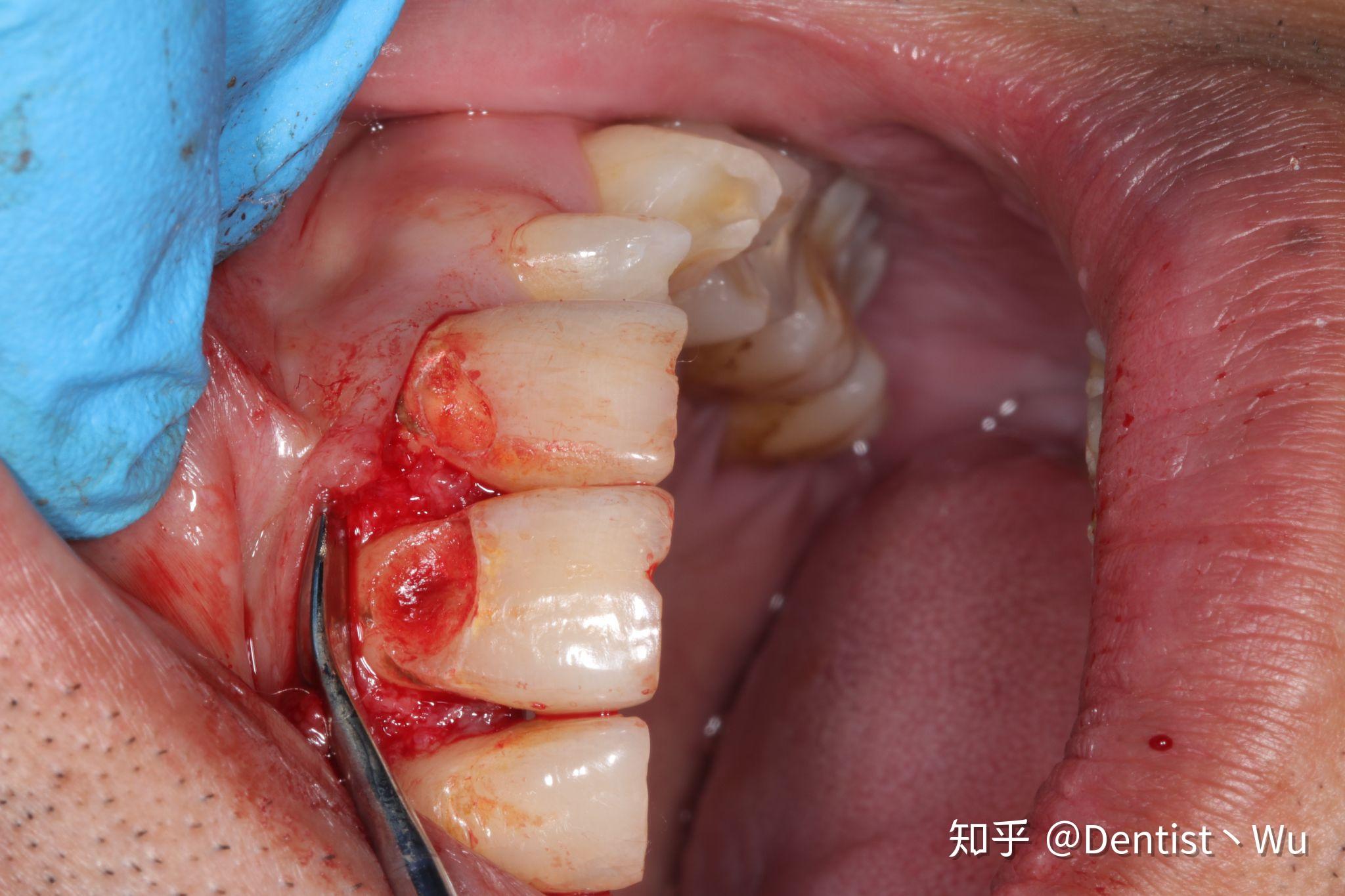 这个程度的楔状缺损该如何处理? - 知乎