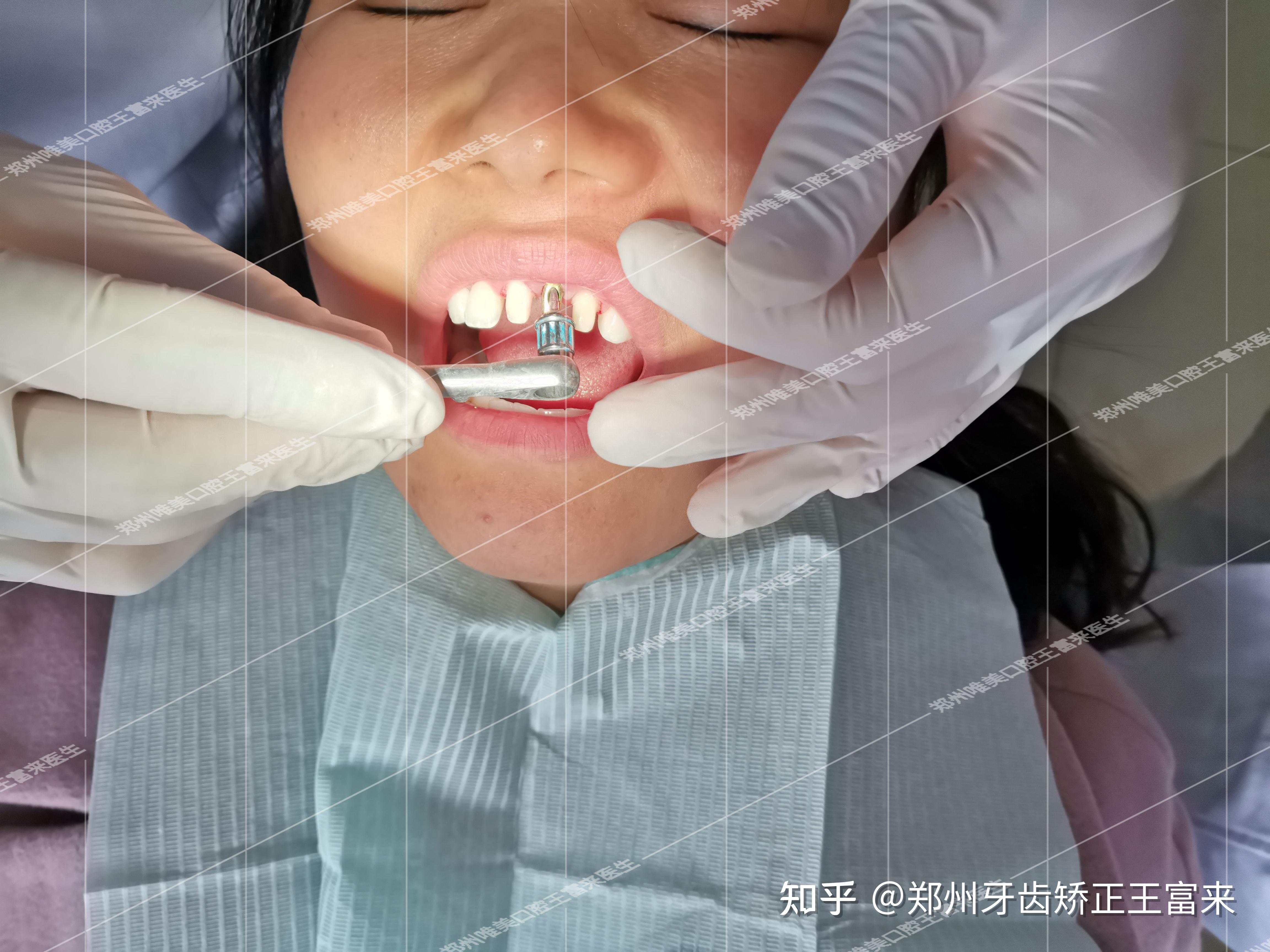假牙固体牙胶影视化妆假牙修饰临时补牙牙胶假断牙牙缝补齐补牙洞-阿里巴巴