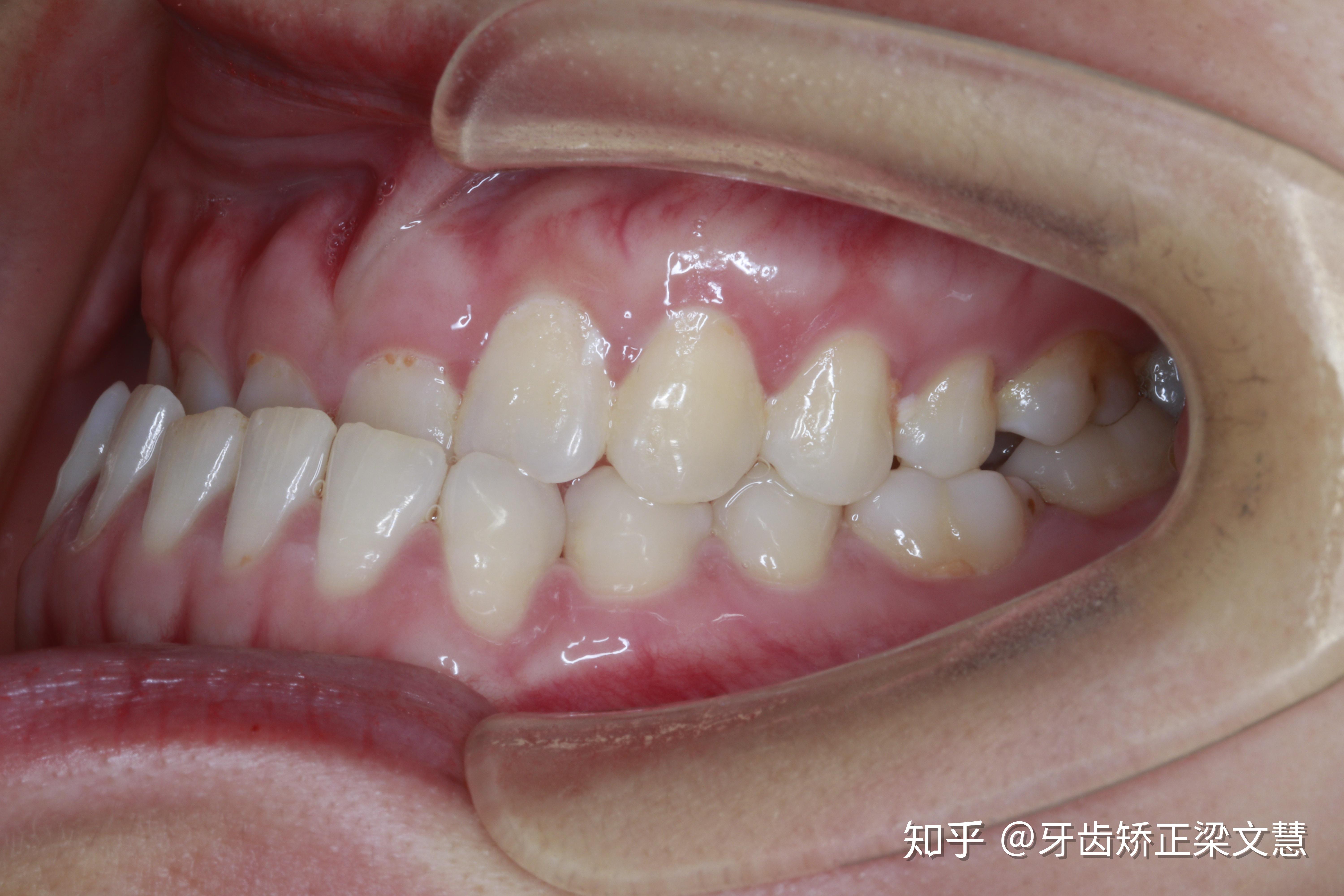 地包天矫正9个月反颌解除,变化喜人| 梁文慧正畸案例