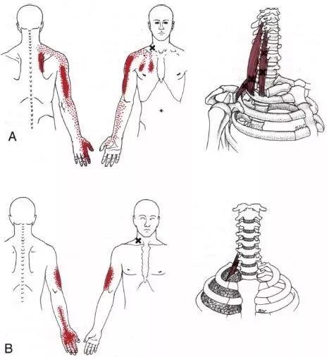 会呼吸的痛—斜角肌,扎心了老铁