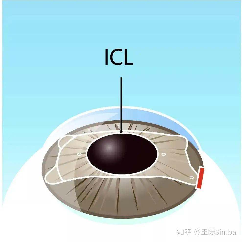 近视眼激光手术：你不可不知的眼科新技术
