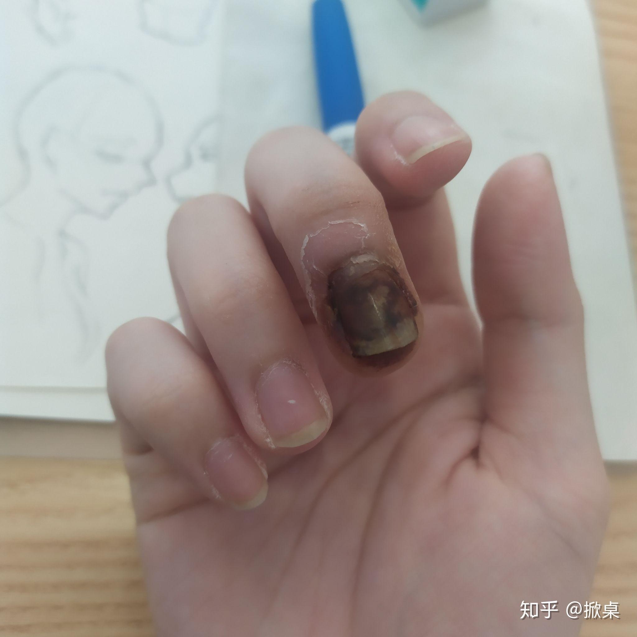 记录📝自己手指甲被夹伤的恢复过程 - 知乎
