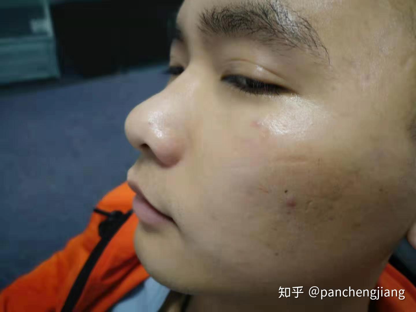 打架指甲挖伤如何避免疤痕