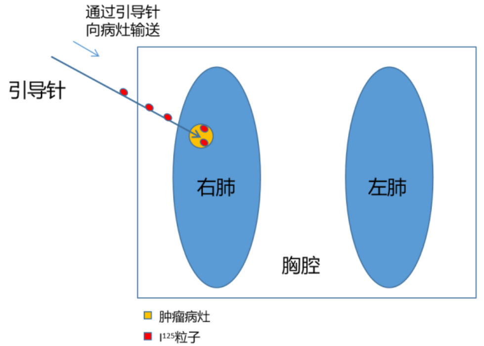 介入治疗(上)常见的介入治疗手段与应用 知乎
