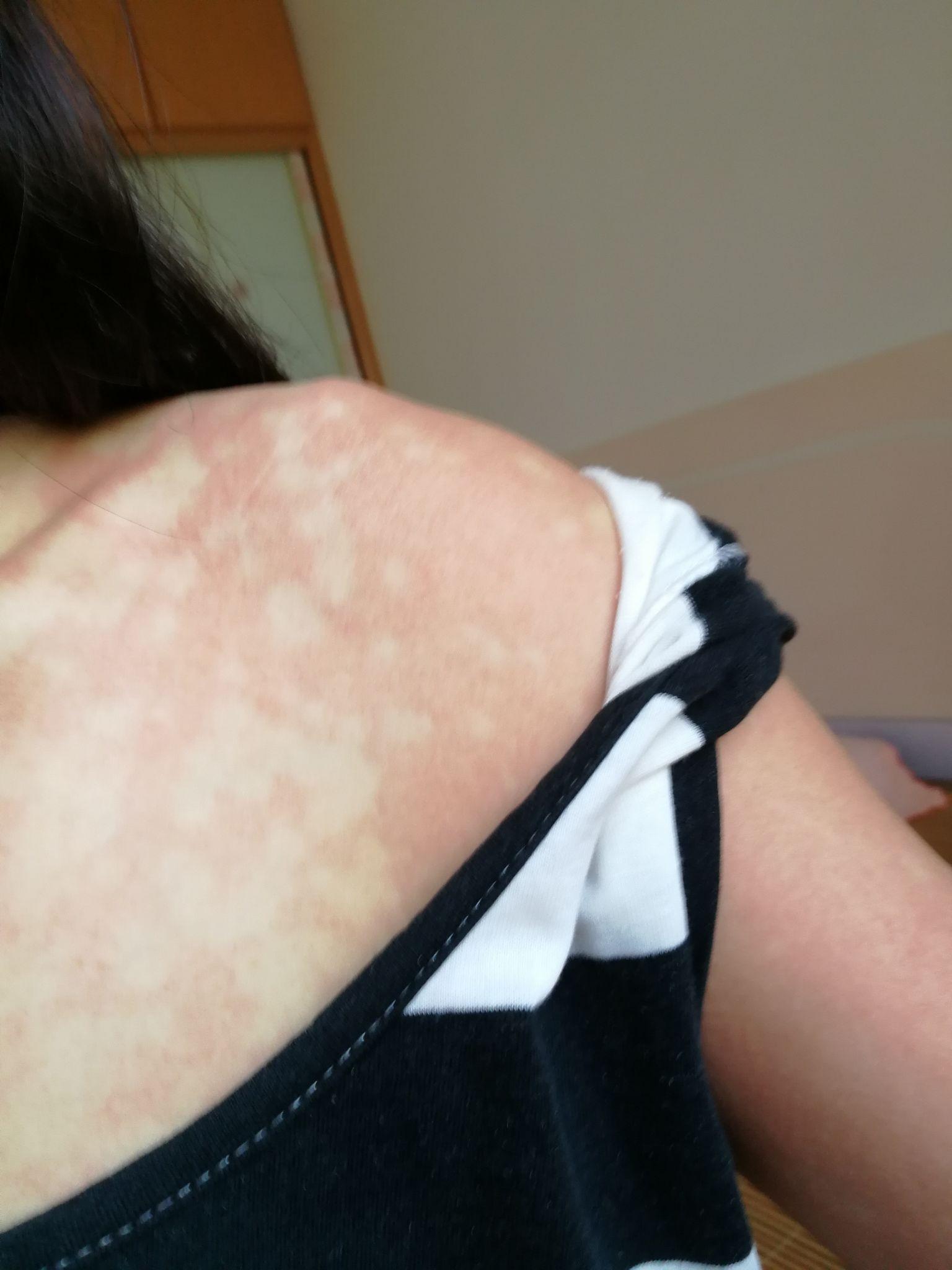 酒精过敏的人喝多了会怎么样? - 知乎