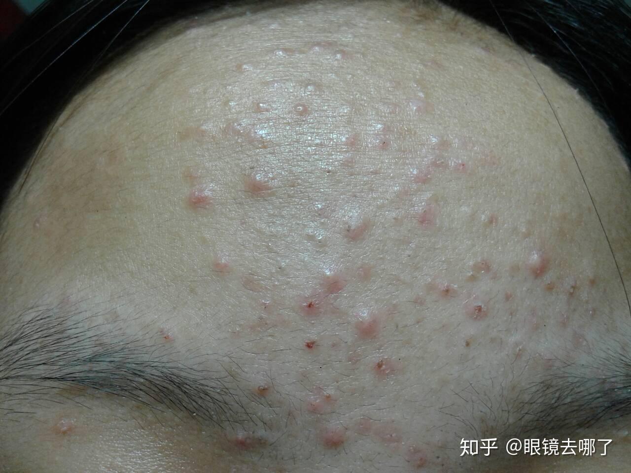 闭口粉刺怎么去除