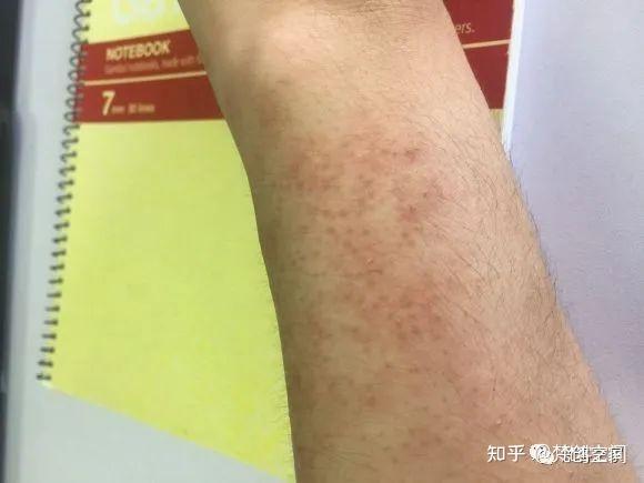 皮肤管理 手臂上有红点是怎么回事 知乎