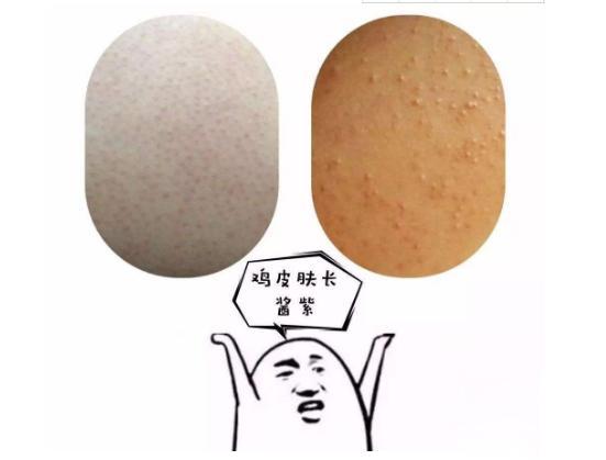 身上长鸡皮肤是什么(身上长鸡皮肤是什么样子)