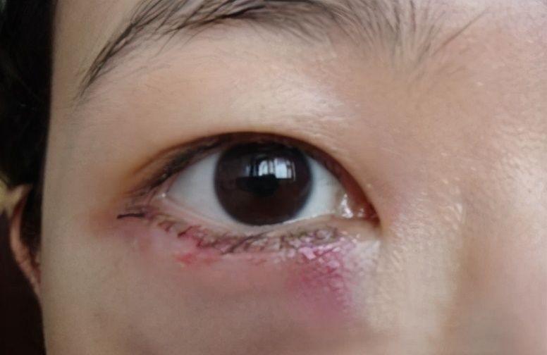 31岁美女眼袋手术后,眼部出现了淤血和泛黄?医生告诉你答案