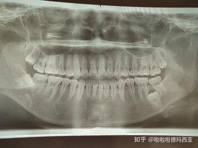 浙一住院全麻拔埋伏牙和3顆阻生齒坎坷經歷