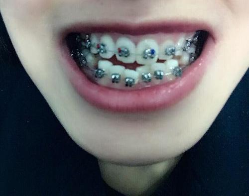 武汉市中心医院矫正牙齿一般多少钱(钢牙牙套的那种)? - 知乎