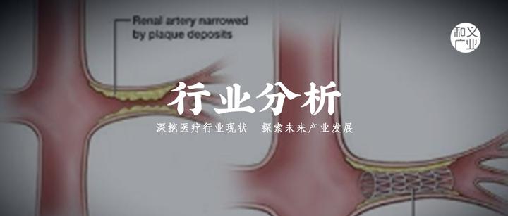 外周血管介入器械2——介绍3种外周动脉疾病介入治疗器械 - 知乎