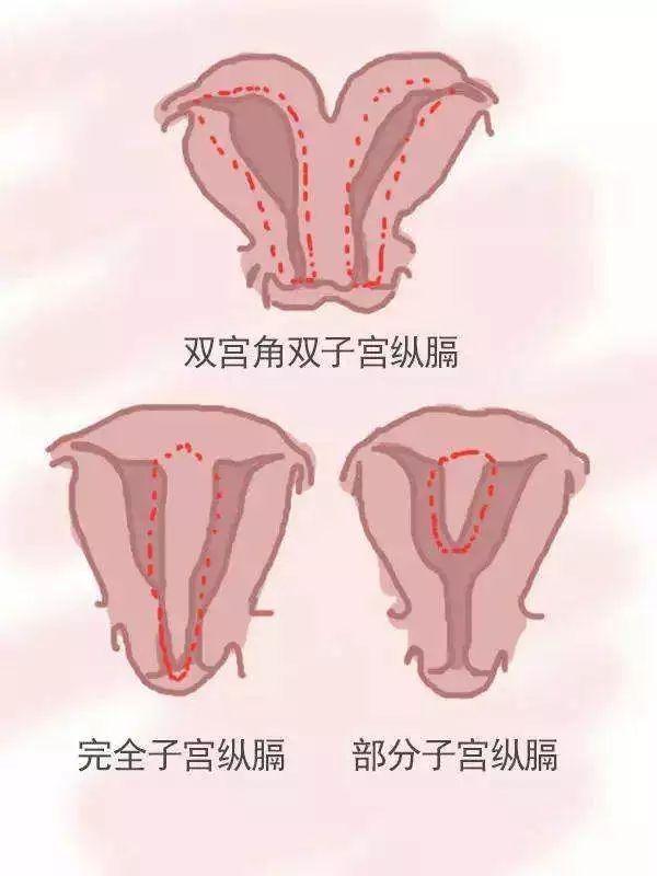 什麼是幼稚子宮?可以做試管嬰兒懷孕嗎?