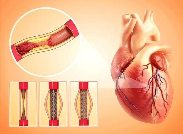 心臟支架10大謠言忽悠了多少人這次心臟醫生闢謠一次說清楚