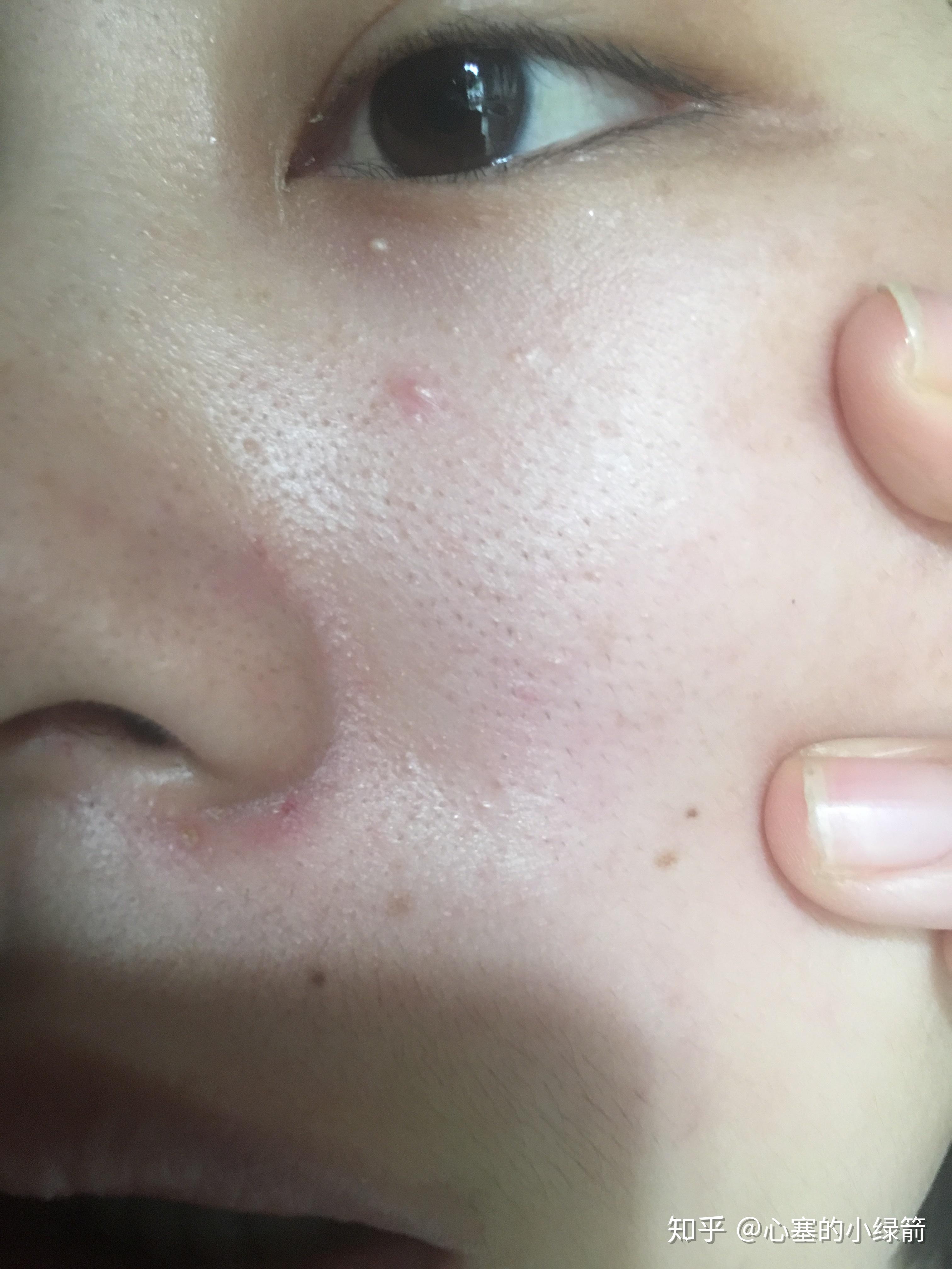 脸颊长毛怎么破