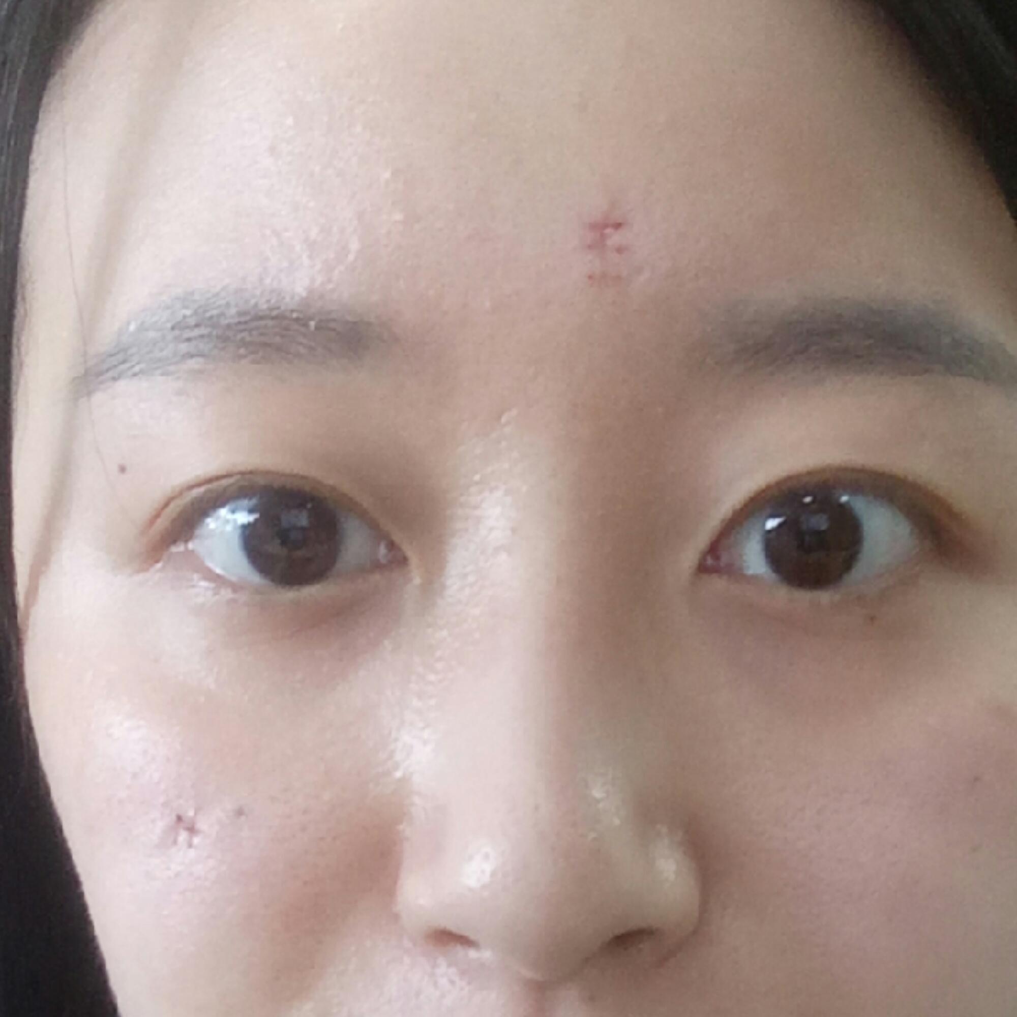 手术切痣是一种怎样的体验?