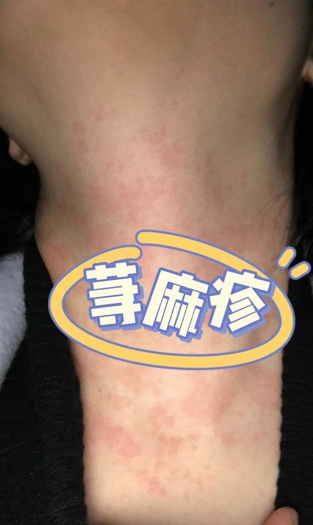 谁有很好根治荨麻疹的办法