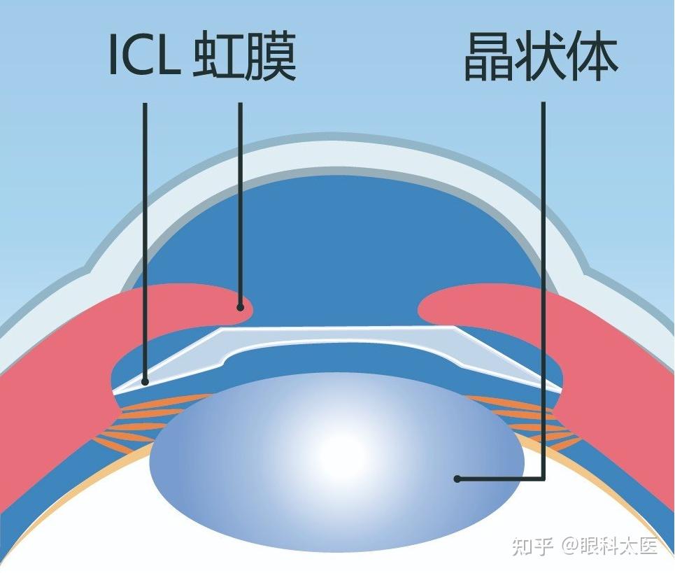 干货科普：4种主流近视手术有什么区别？ - 知乎