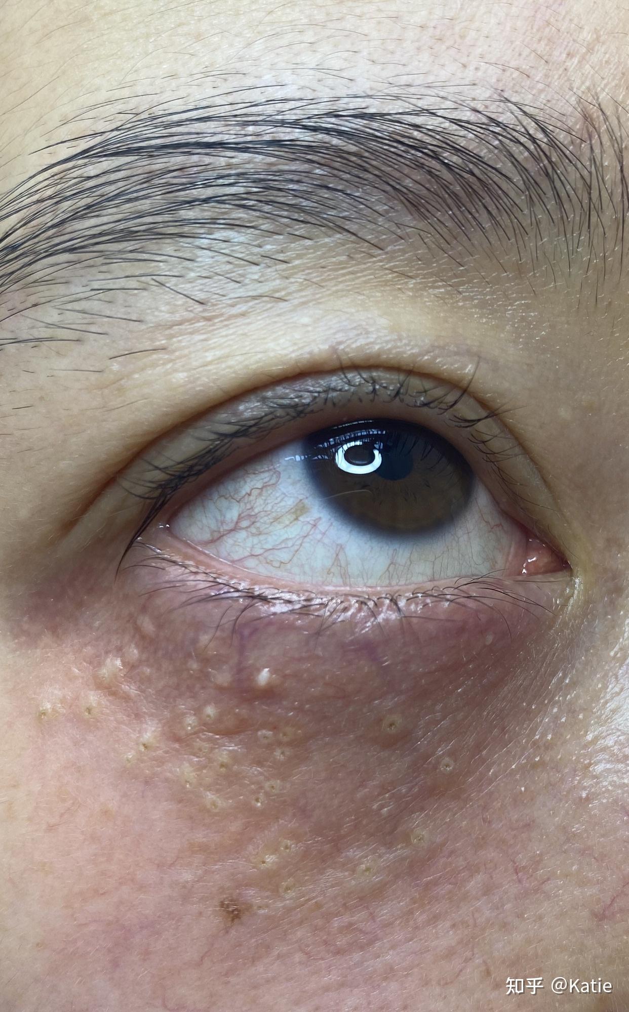 电解质汗管瘤恢复日记