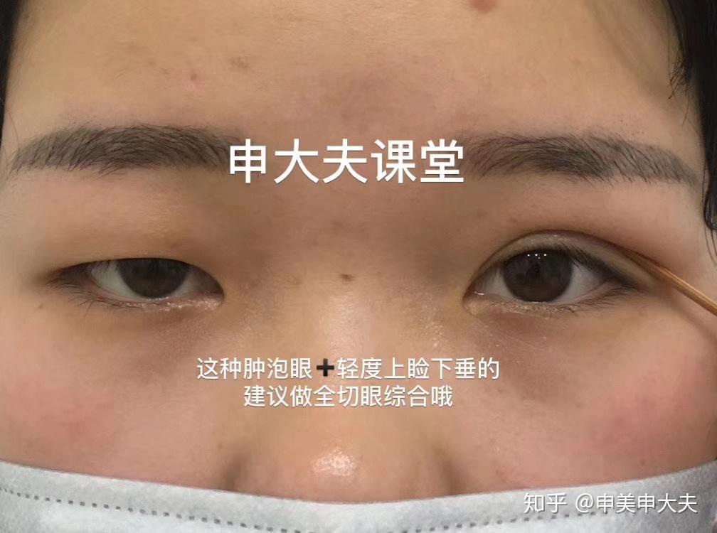 怎樣才可以瘦眼皮啊我是脂肪型腫眼泡不抽脂不打針