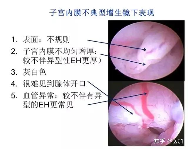 宫腔镜有哪些适应证禁忌证