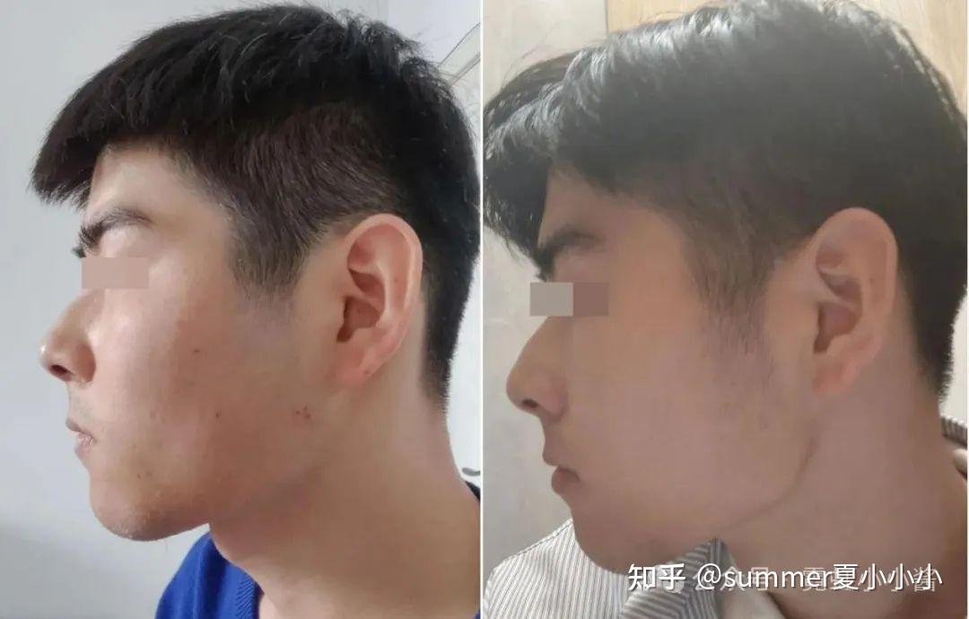 舌头贴上颚,能让鼻基底变高、脸变立体变好看? - 知乎