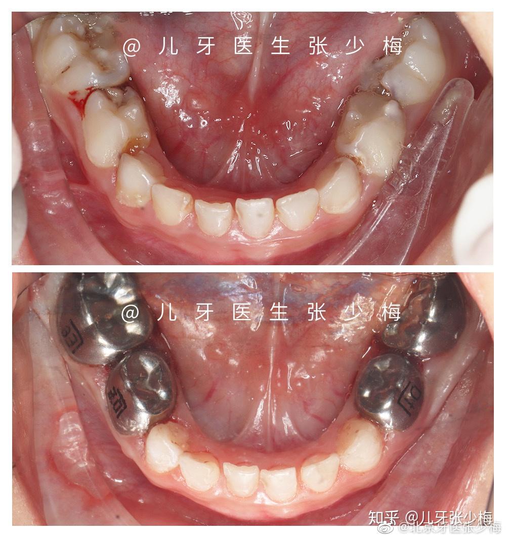 主要針對咬合面齲齒,第一顆乳磨牙一歲半左右萌出,第一顆恆磨牙六歲