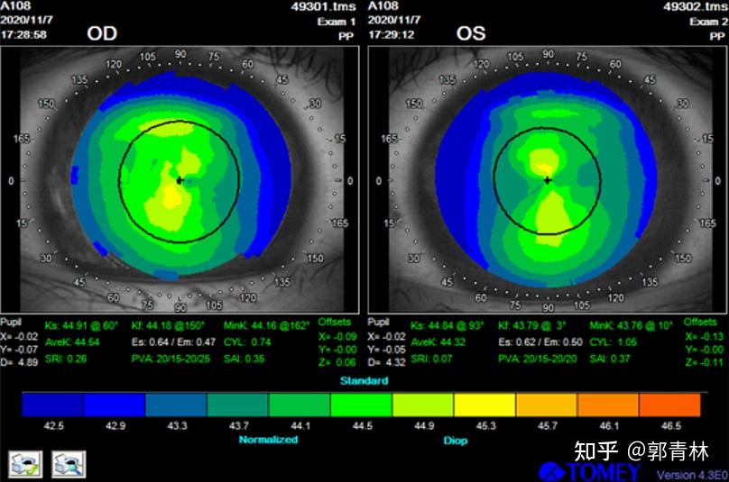 原始角膜地形圖如下:e值: od:0.64/0.47 os:0.62/0.