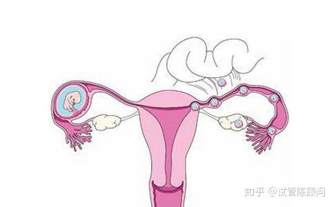 子宫萎缩能做试管婴儿吗