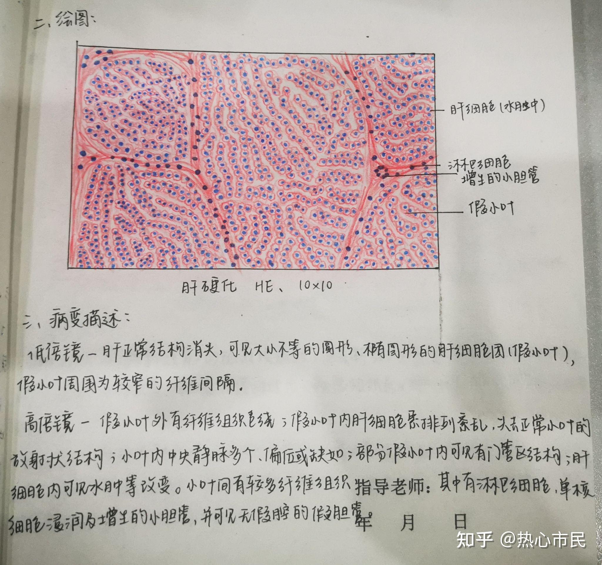 肝硬化8915潰瘍病8915新月體型腎小球腎炎8915199 人贊同