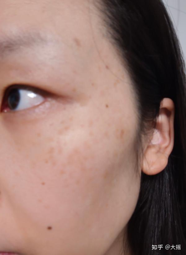 2023.5.18记录做皮秒祛褐青色痣以及反黑情况 - 知乎