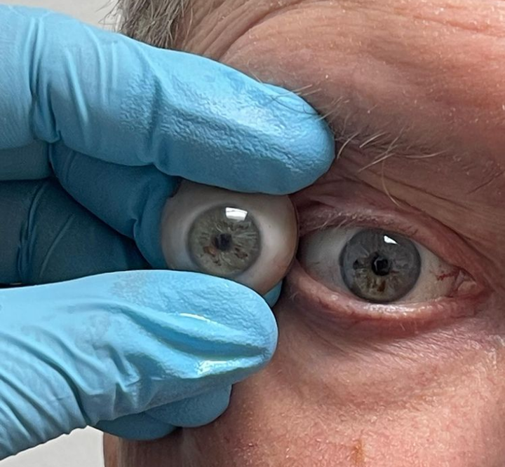 武汉美目义眼为什么你不能佩戴义眼片