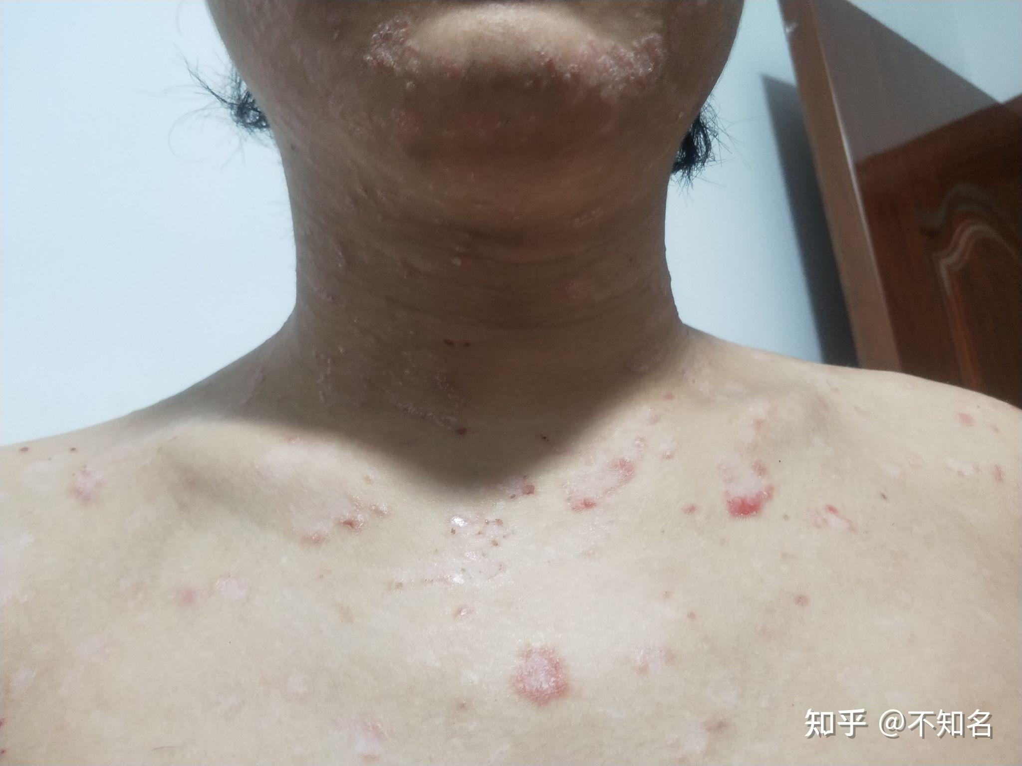 牛皮对生活的影响