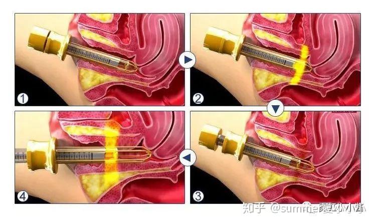 阴道疼是什么阴道炎 v2-66104077d4c07de433685b6aea788f34_r.jpg