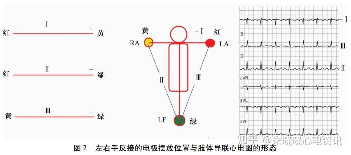 图解肢体导联电极错接的心电图表现